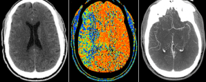 diffusion